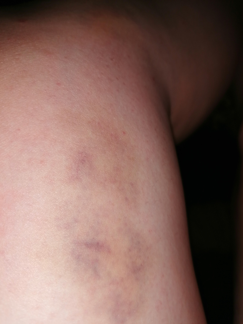 Large bruise on a Leonie's thigh. The bruise is a purplish-brown colour and covers a significant portion of the visible skin. The skin itself appears pale. The lighting is somewhat dim.