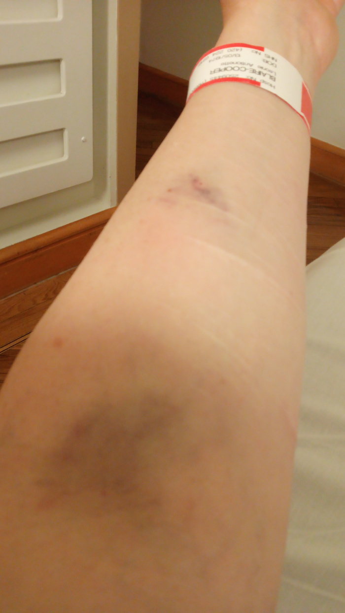 Leonie's forearm with several bruises and what appear to be needle marks. The arm also has a hospital identification wristband. The overall impression is one of recent medical treatment or injury.