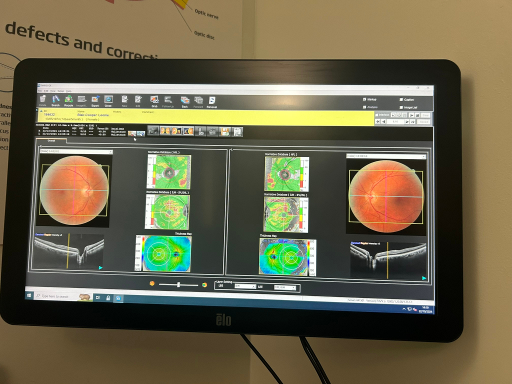 Computer screen displaying ophthalmology data. Specifically, it shows a detailed scan of a patient's retina, including color images and various quantitative analyses (thickness maps, normative database comparisons). The software appears to be a specialised ophthalmic imaging analysis program. The screen captures multiple views of the retina— a full-field image and cross-sectional scans — providing comprehensive information for diagnosis and treatment planning, likely related to macular thickness and retinal nerve fibre layer analysis. There is patient information visible, including an ID number and date of birth, suggesting a clinical setting. The overall impression is a technical record of a retinal examination.