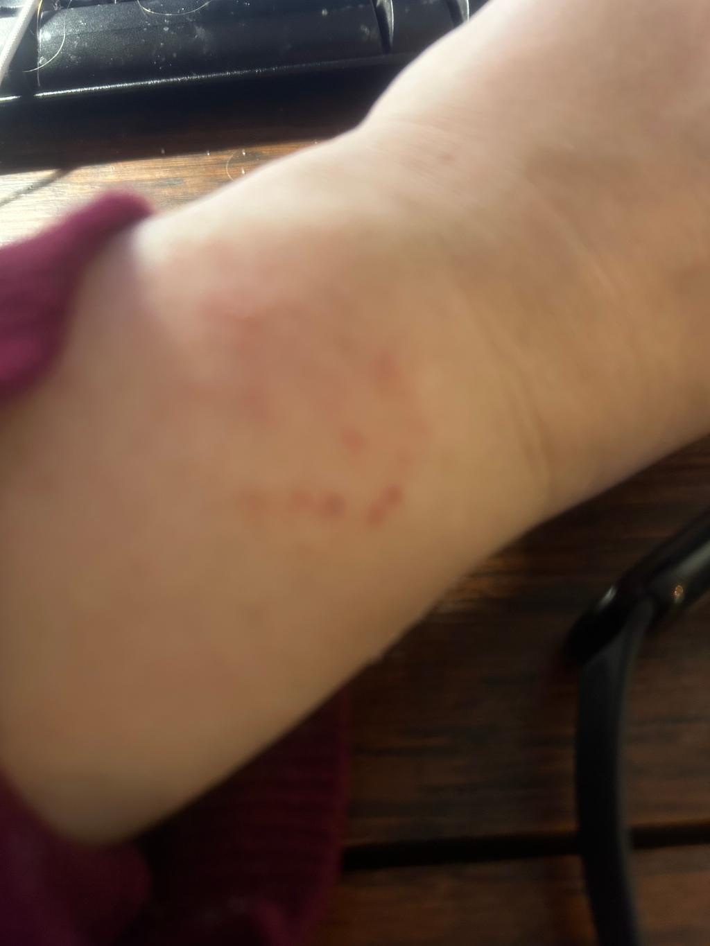 Close-up view of Leonie's forearm, resting on a dark brown wooden surface. There is a noticeable, slightly raised, reddish mark or rash in a roughly circular shape on the inner forearm. Part of a dark purple or burgundy sleeve is visible at the edge of the frame. A portion of a dark-coloured object, possibly a piece of electronics, is also visible in the bottom right corner. The overall impression is one of a possibly medical issue or skin irritation.