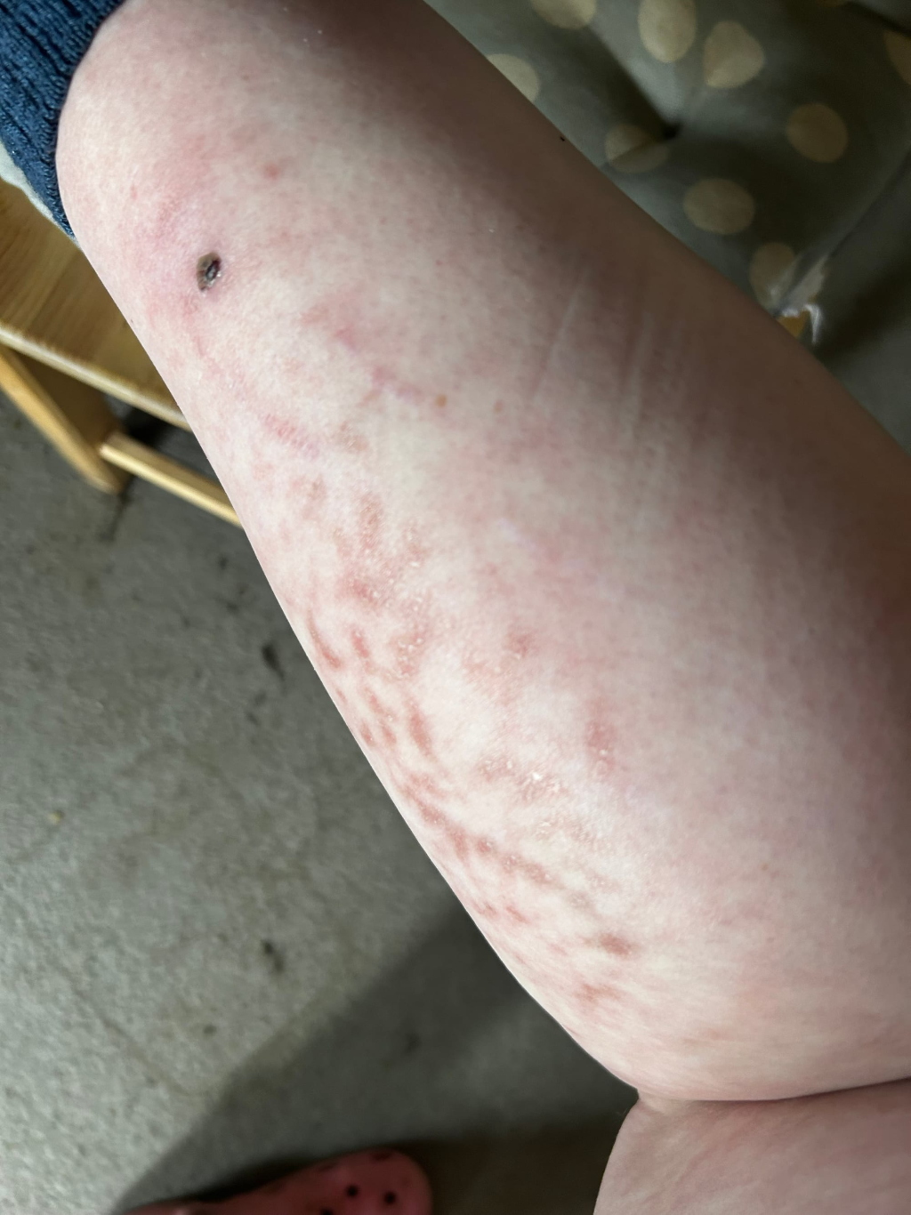 Leonie's calf muscle with numerous thin, light brown blotches arranged in a pattern. The blotches appear to be linear and somewhat parallel to each other. There is also a small, dark spot visible on the upper part of the calf. The skin surrounding the blothes appears slightly reddened. The overall impression is of a medical condition or the result of an allergic reaction.