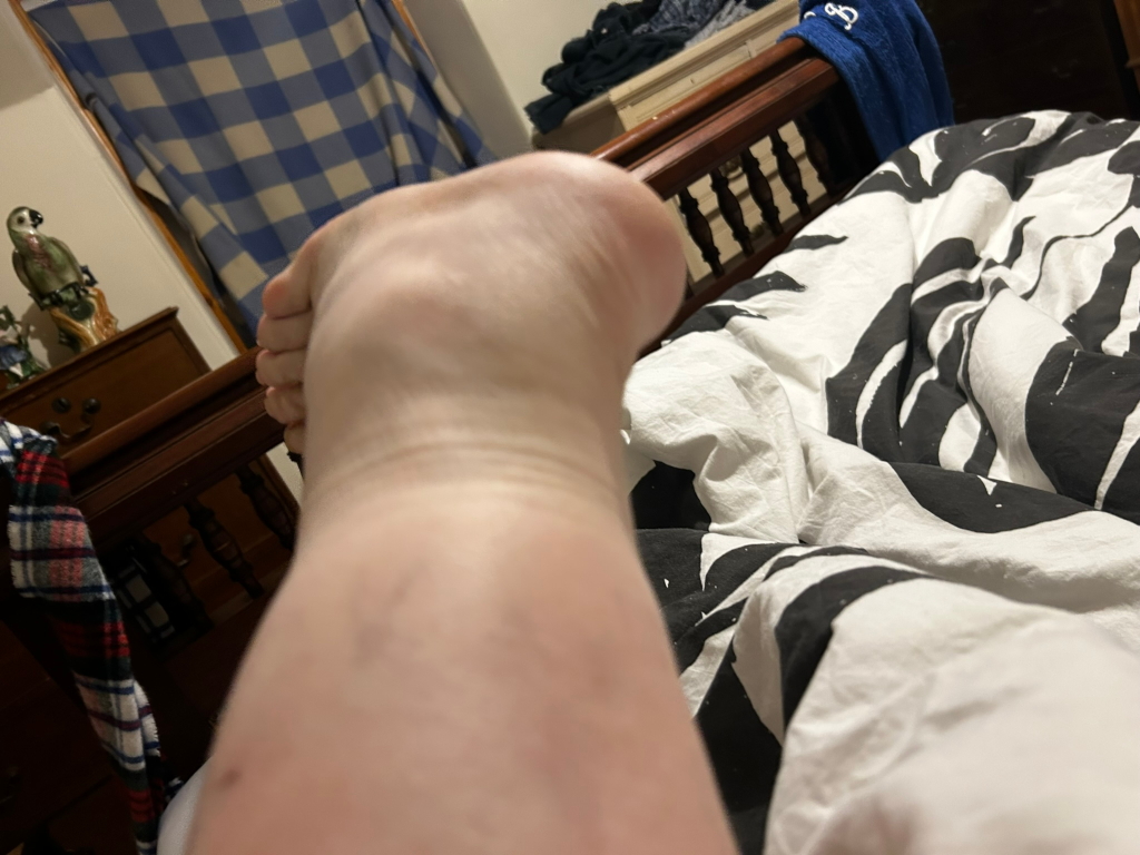 Close-up, low-angle shot of Leonie's swollen leg and foot, positioned above a bed with a black and white patterned duvet. The foot is slightly elevated, and the focus is primarily on the lower leg and ankle. The background includes a portion of a wooden dresser, a blue and white chequered blanket, and a small decorative parrot statue. 