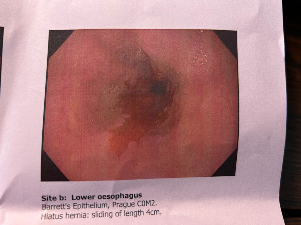 Close-up endoscopic photograph of the lower oesophagus. The photo shows an area of Barrett's epithelium (a type of abnormal cell growth) and a sliding hiatus hernia (a condition where part of the stomach pushes up through the diaphragm). The accompanying text provides the location (lower oesophagus), diagnosis (Barrett's epithelium and hiatus hernia), and the length of the hernia (4cm). The image is a medical diagnostic record, not an artistic expression. There is no creative background, emotional expression, or moral to interpret.