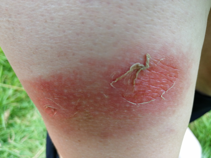 Close-up view of a scolded leg with a blistered area. The skin is red, inflamed, and peeling, indicating a significant burn. There’s a noticeable, slightly raised, peeling blister in the centre. The surrounding skin is also red and irritated. The background is blurred but shows green grass, suggesting an outdoor setting.