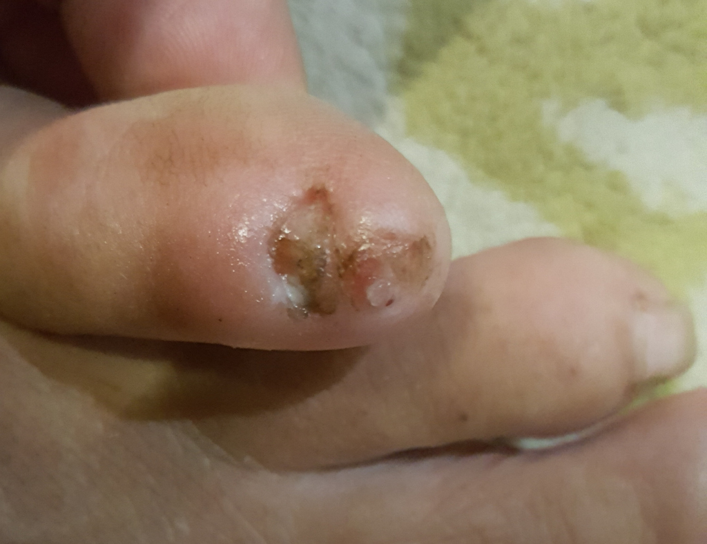 Close-up shot focusing on a small, injured toe. The toe exhibits a lesion or wound on its top surface, near the toenail. The lesion is roughly oval, with a dark brown-black scab-like center surrounded by a lighter, slightly raised, and seemingly moist, whitish area. The skin around the lesion is red and inflamed, indicative of recent injury or ongoing healing. The toe itself is slightly swollen. The rest of the foot, visible in the foreground and slightly out of focus, appears pale and normal. The toes are relaxed and not actively engaged in any action The background is blurred but shows a textured surface, possibly a towel or fabric, with muted, pale olive-green and beige tones. The lighting is soft and appears somewhat artificial, neither harshly bright nor dimly lit. The colours are relatively muted and natural, with the emphasis being on the skin tones of the foot (pale pink, red inflammation, dark brown scab)..