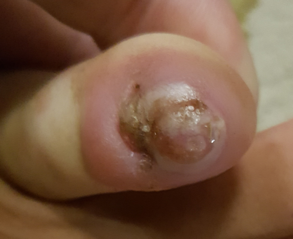 Severely infected or injured toenail, occupying the majority of the frame. The toenail itself is the focal point. It's swollen and inflamed, exhibiting a deep reddish-pink hue around the edges. The nail bed is visibly damaged; a significant portion of the nail is missing or detached, revealing a raw, brownish-grey, possibly necrotic area underneath. This damaged area has a somewhat crusty texture with flecks of what appears to be dried blood or serum. The surrounding skin is also red and swollen, indicating infection or trauma. The toe itself is slightly curled, possibly due to pain or discomfort. The hand holding the toe is only partially visible, appearing fair-skinned. There's no action depicted; it's a static image of an injury.