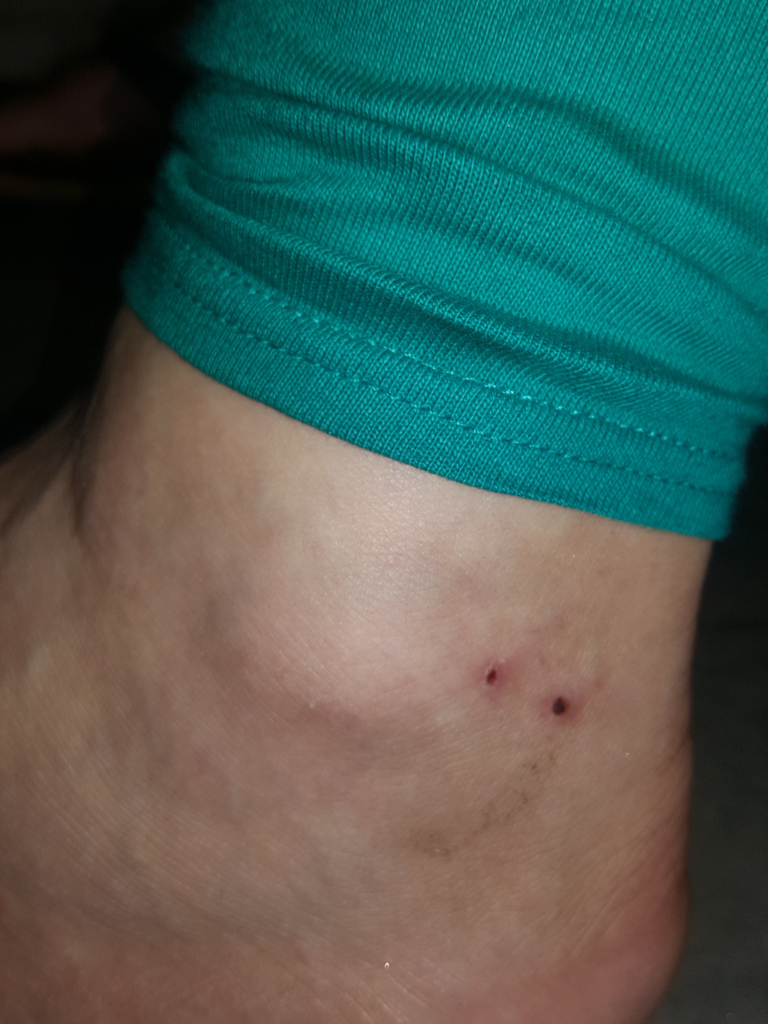 Close-up view of Leonie's lower leg and ankle. The focus is on her ankle area, where two small, reddish-brown punctures are visible on the skin. These punctures appear to be superficial wounds, possibly from snake bite. The skin around the punctures has a slightly discoloured, possibly slightly inflamed appearance, and there is some light dirt or debris visible. Her lower leg is covered by teal or turquoise fabric, which appears to be a piece of clothing, possibly leggings, bunched slightly around the ankle. The fabric is soft and has a ribbed texture. Her skin is light-toned, with visible veins and skin texture. No other body parts or people are visible.