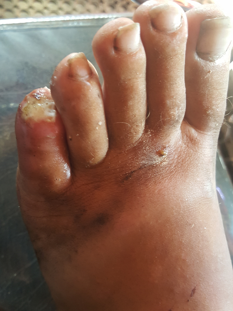 Close-up view of a Leonie's foot, specifically the toes and the top of the foot. The foot is positioned diagonally across the frame, with the toes pointing towards the upper left corner. The foot appears to belong to a person with dark skin. The toes are dirty and show signs of significant damage and infection. The big toe exhibits a particularly alarming condition with a yellowish-white, pus-like substance visible around the toenail, and reddish inflamed skin. The other toes have discoloured nails and dirt embedded in the skin. The top of the foot is also dirty, with patches of dark discoloration and what seems to be dried dirt or possibly dried blood in some areas. There are small abrasions or minor cuts visible on the arch of the foot. The foot is not engaging in any specific action; it's simply presented for observation.