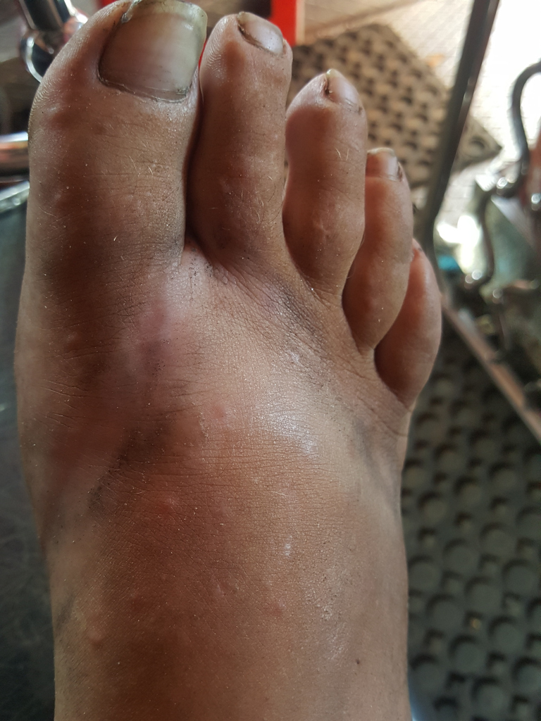 Close-up shot of a Leonie's right foot, positioned diagonally across the frame. The foot is dark-skinned, with visible dirt and grime accumulated on the sole and between the toes. The toenails are unevenly cut and show signs of dirt underneath. There are several small, light-colored spots or blemishes scattered across the skin of the foot, suggesting possibly dryness, minor abrasions, or a skin condition. The toes are slightly curled, and the foot appears relaxed but not actively engaged in any movement.