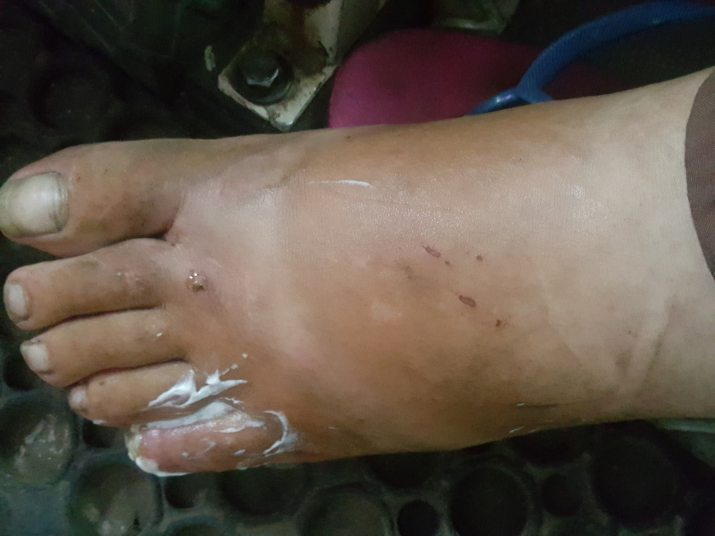 Close-up shot of Leonie's left foot, positioned at a slight angle, with the toes pointing towards the lower left corner. The foot appears to be that of an adult. The foot's skin is visibly swollen and inflamed, exhibiting a reddish-brown hue, particularly concentrated on the sole and arch. Several small, superficial scratches or abrasions are visible on the top of the foot, appearing as faint red lines. A small, dark spot, possibly a puncture wound or insect bite, is noticeable near the base of the second toe. A generous amount of white, ointment-like substance is applied to the sole of the foot. Leonie is wearing a brown sock or legging that partially covers the lower leg, just above the ankle.