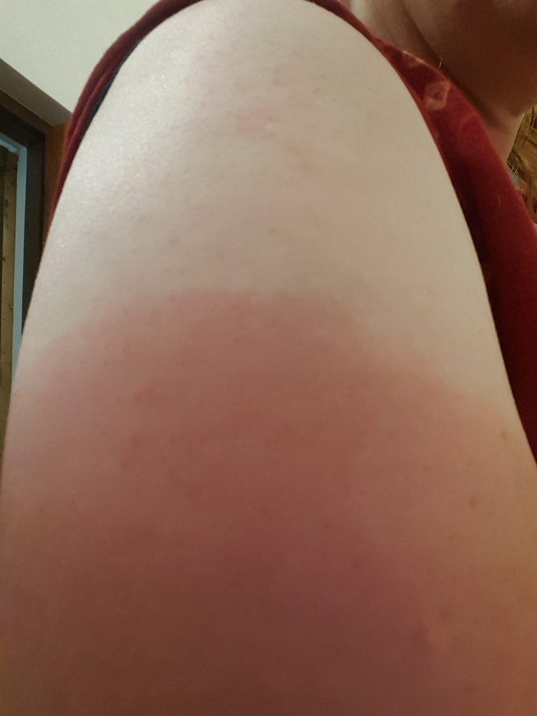 Close-up, slightly high-angle shot focusing on a person's upper arm and shoulder. The arm is positioned diagonally across the frame, extending from the upper left to the lower right. The person is not actively doing anything; the arm is simply presented for observation. The skin shows significant sunburn, with a distinct line delineating the area exposed to the sun (a deep, reddish-brown hue) from the unexposed area (a much paler, almost white tone). The sunburn appears blotchy and slightly textured. The skin also exhibits several small, scattered blemishes or freckles, most visible in the less sunburnt area. A portion of a maroon-coloured garment is visible at the top and side of the frame, indicating clothing on the person. A small, indistinct part of an earring or similar accessory is slightly visible near the shoulder.