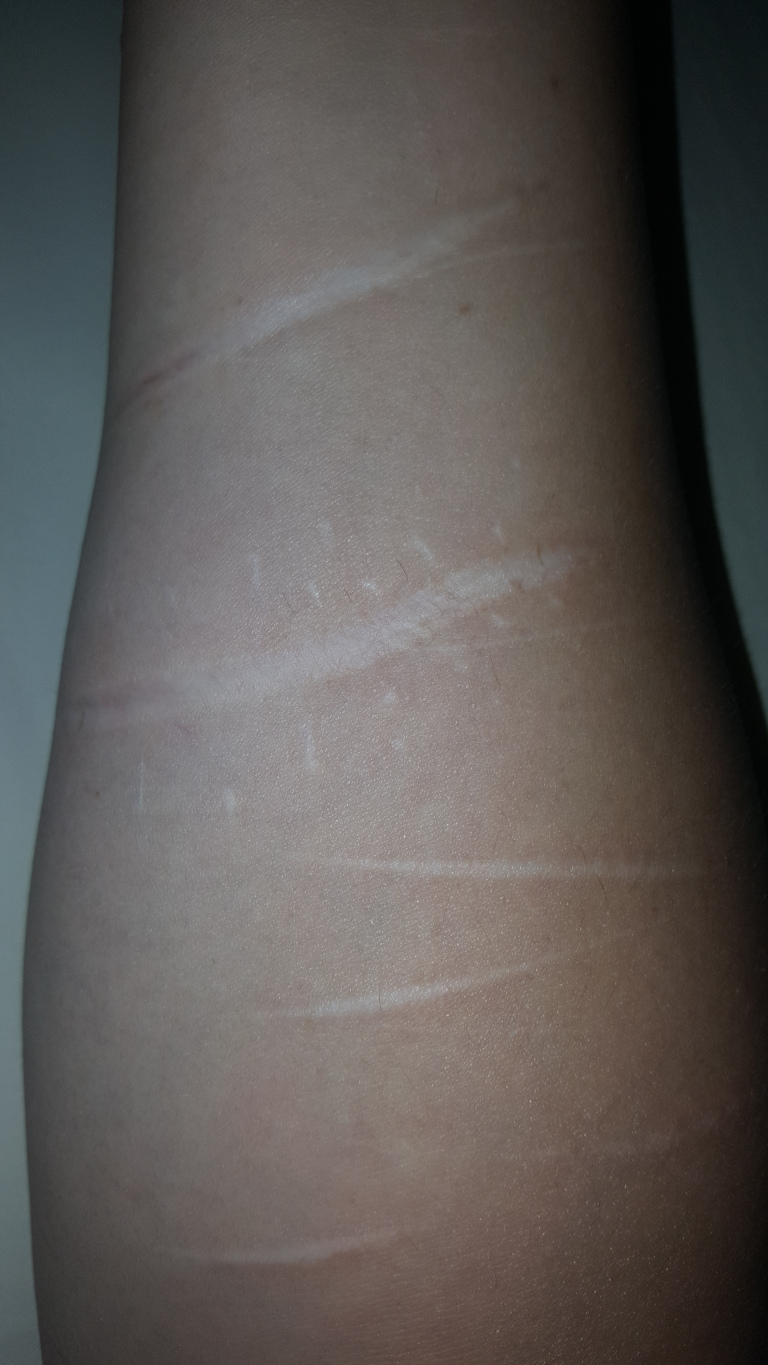 Pale, linear scars etched across the skin's surface. These marks vary slightly in width and depth; some are fainter and barely visible, while others are more pronounced, appearing as thin, white lines against the warmer skin tone. The streaks are mostly horizontal but display some subtle curves and slight deviations from perfect parallelism, suggesting a degree of irregularity in their formation. The skin itself has a slightly rough texture, visible in fine granularity. Fine hairs are sparsely visible, adding to the skin's realistic depiction. No other objects or people are present.