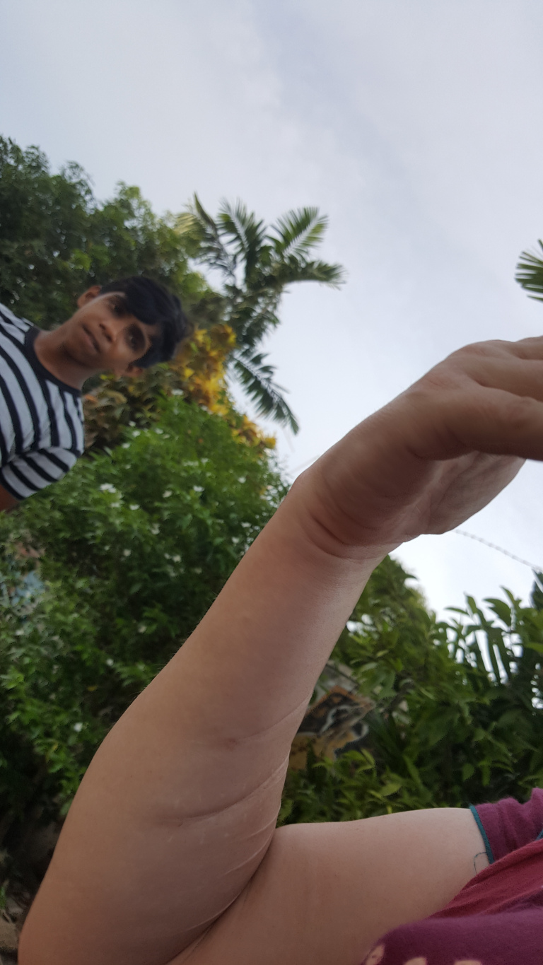 Dynamic, low-angle close-up shot focusing on a fair-skinned arm extended diagonally across the frame, partially obscuring a Asian person in the background a light-skinned individual's arm dominates the foreground. It's outstretched, its hand slightly cupped, almost as if reaching or gesturing. The arm displays visible, light-coloured scars running along the length of the bicep and forearm. The skin tone is pale with a warm undertone. The arm is muscular, indicating some strength and physical activity. A glimpse of a maroon shirt sleeve is visible at the elbow/upper arm, suggesting casual wear.